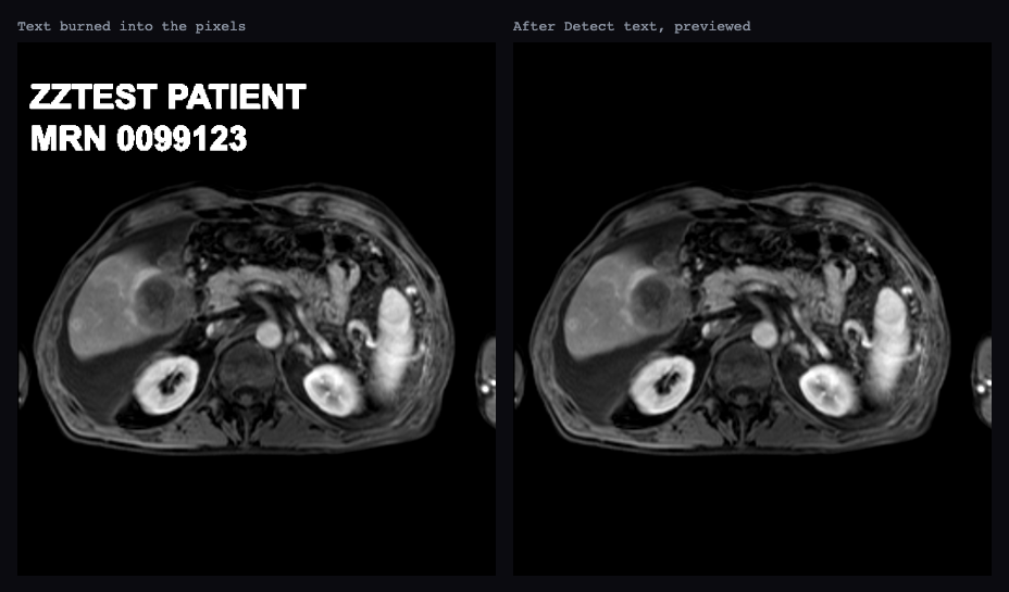 An MR slice with a patient name and MRN burned into the pixels, and the same slice after Detect text with the text blacked out